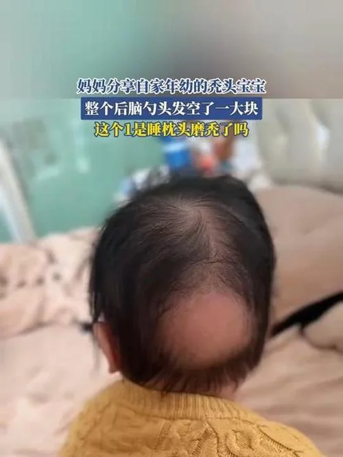 梦见儿子掉头发快秃了_2