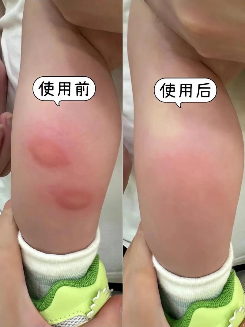 婴儿蚊虫叮咬红肿怎么办-婴儿蚊虫叮咬红肿处理