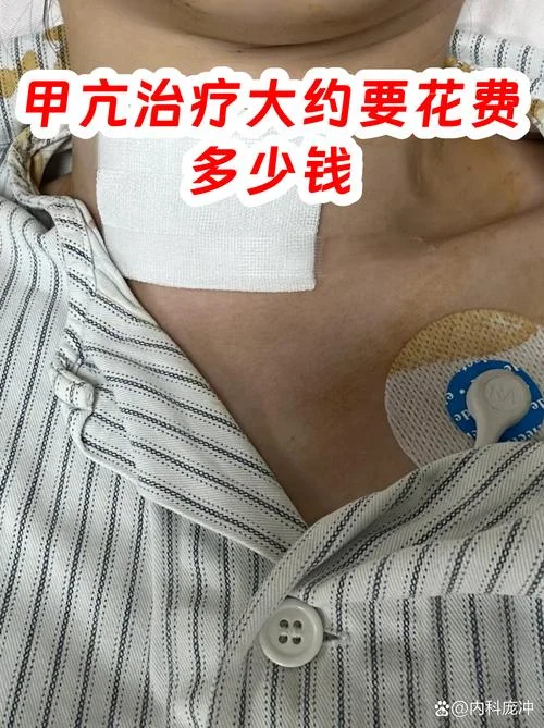甲亢治好需要花多少钱_1