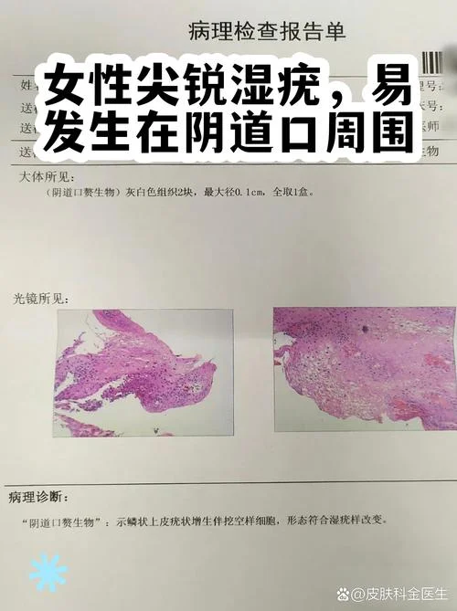 什么是尖锐湿扰-什么是尖锐湿扰