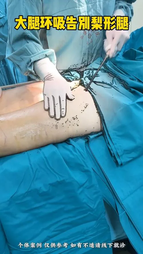 做大腿抽脂手术多少钱_1