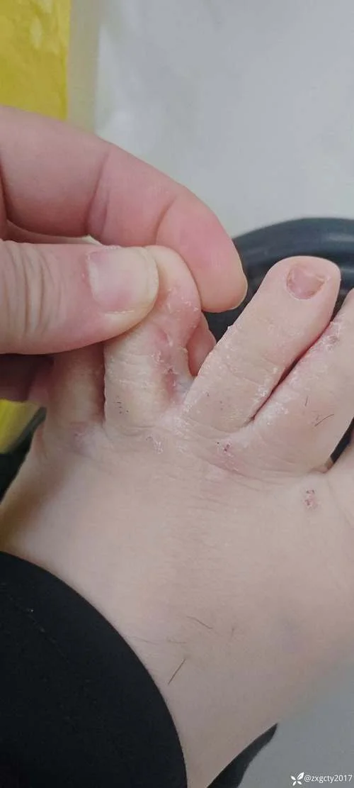 长沙治足癣多少钱_1