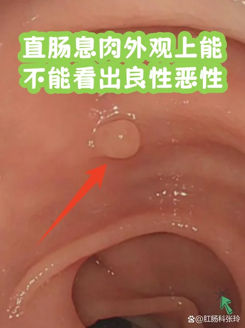 什么是直肠山田1型息肉_2