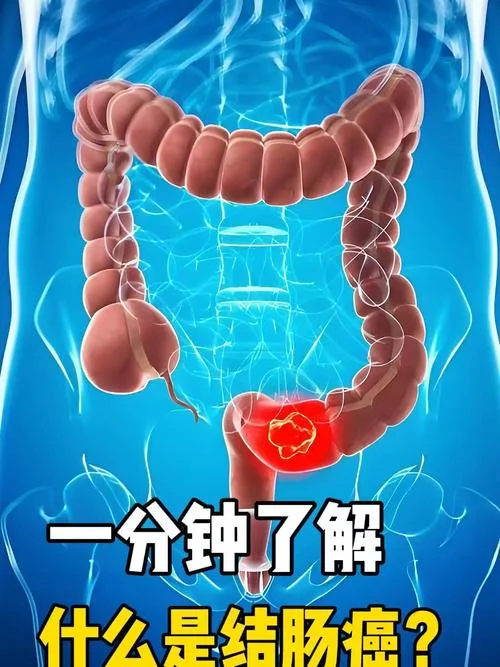 结肠癌介绍_2