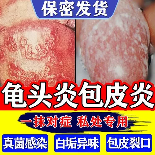 龟头流脓买什么药-龟头流脓需用药