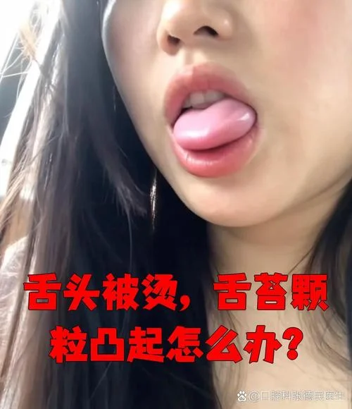 舌苔被烫没有了怎么办_2
