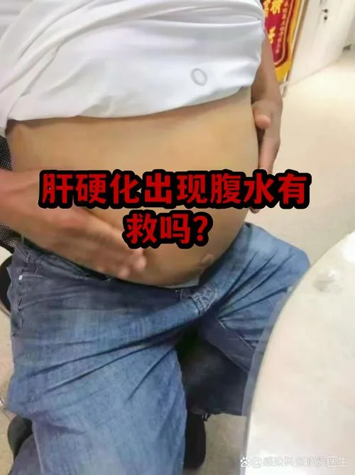 肝硬化腹水感悟_2