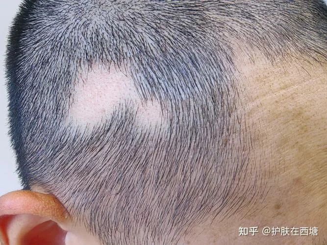 梦见后脑勺头发稀少_2