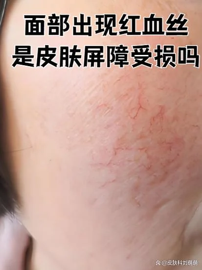脸上红血丝很多怎么办_1