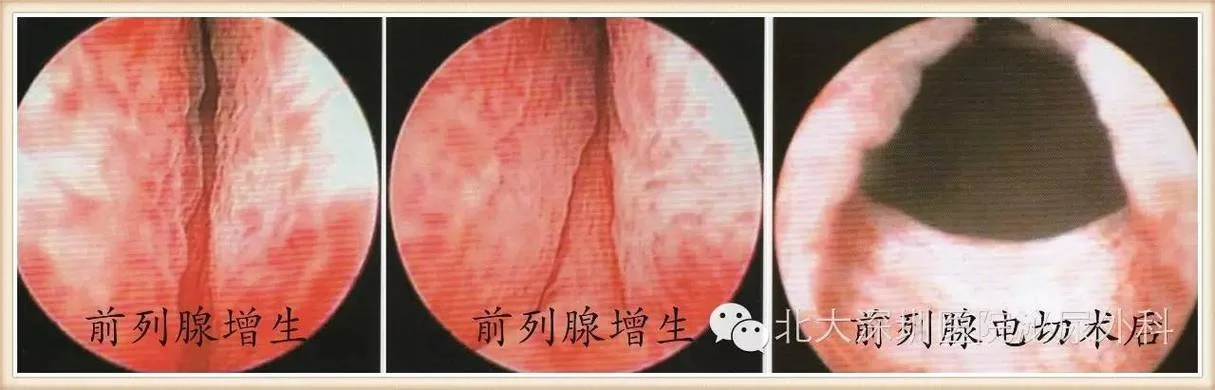 无痛膀胱镜检查多少钱_2