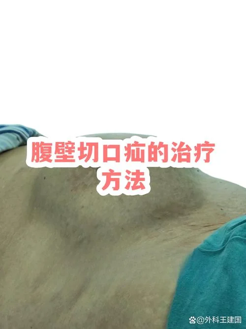 微创治疝气大约多少钱_1
