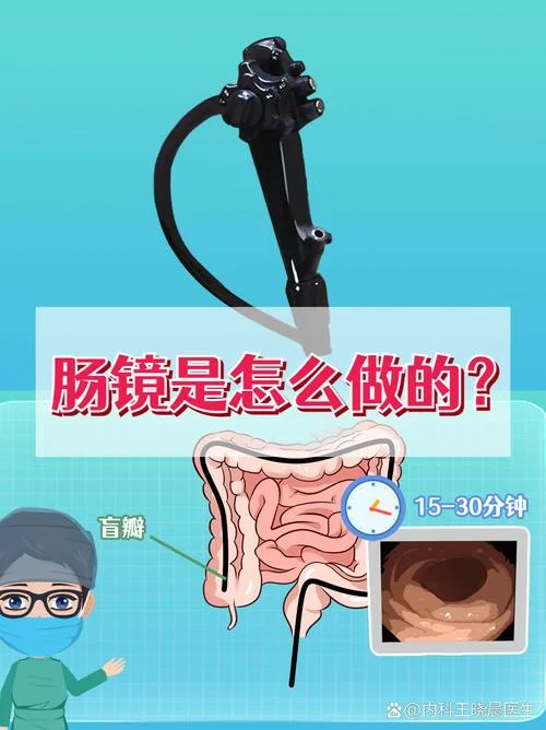 如何做肠镜肠癌筛查_1