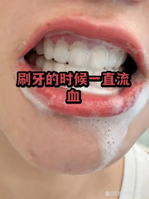 做梦牙龈出血满嘴吐血_1