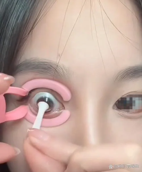 美瞳感染了怎么办-美瞳感染怎么办