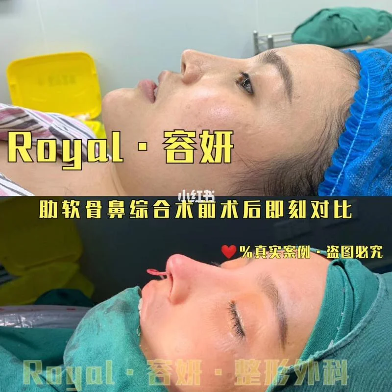 鼻综合肋骨手术多少钱_2