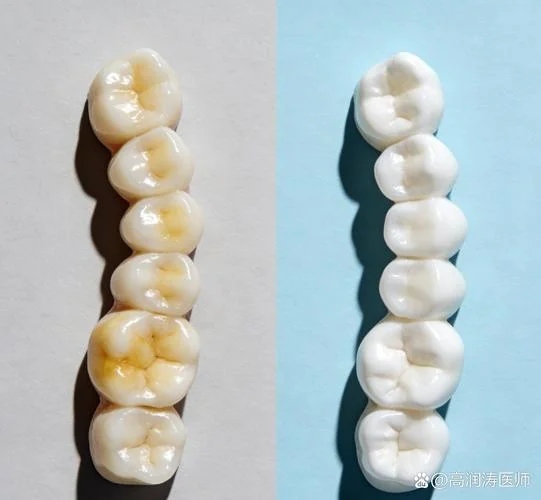 漂白牙齿要多少钱_1