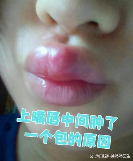 梦见嘴唇肿起来了_1