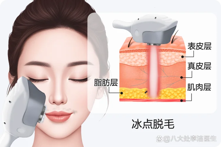 冰点脱毛胡子要多少钱_1