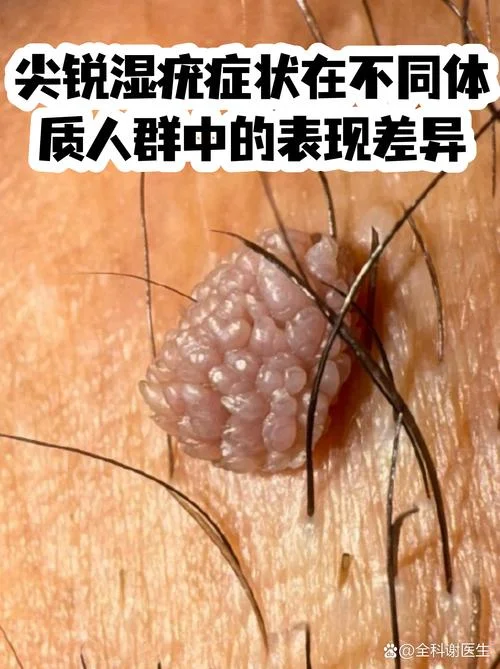 尖锐湿疣治疗多少钱-尖锐湿疣治疗花费