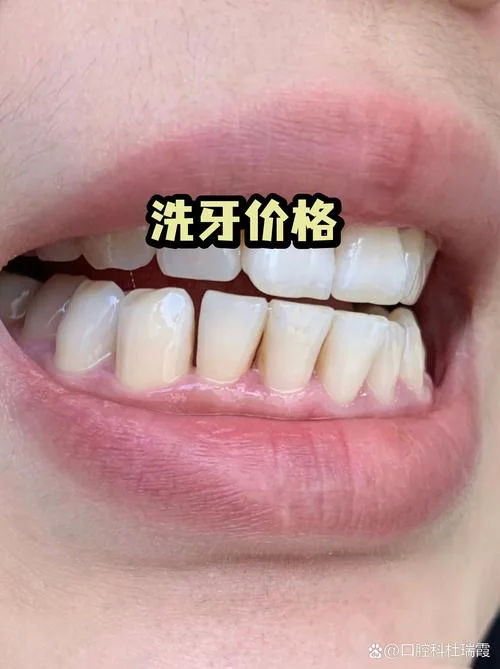 西安洗牙多少钱一次_1