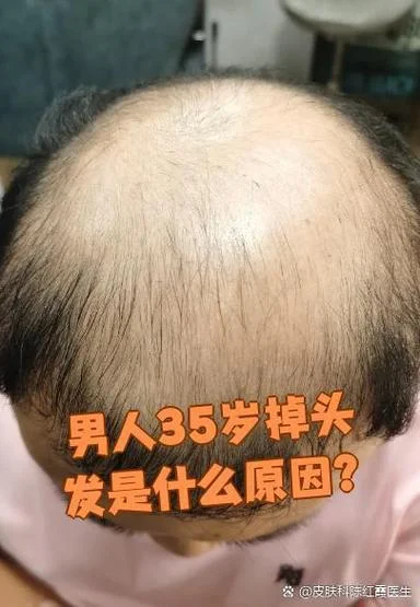 男人梦到掉头发_1
