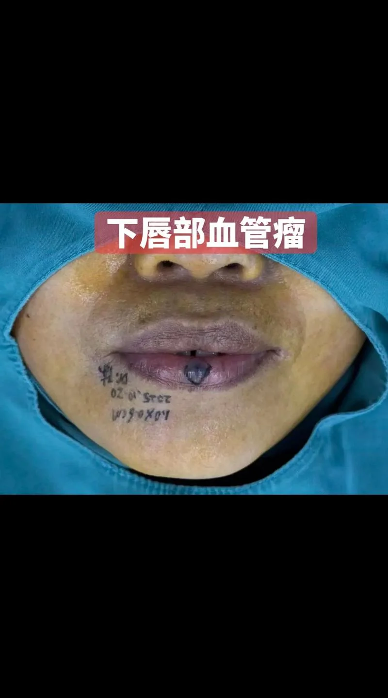 血管瘤手术_1