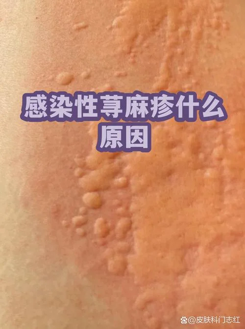什么是热性荨麻疹_2