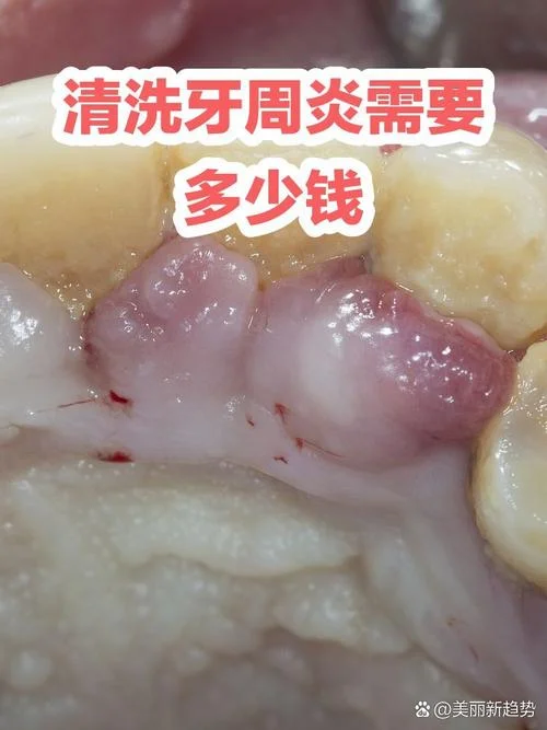 医院洗牙多少钱一次-医院洗牙单次费用