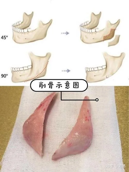 磨脸骨需要多少钱_1