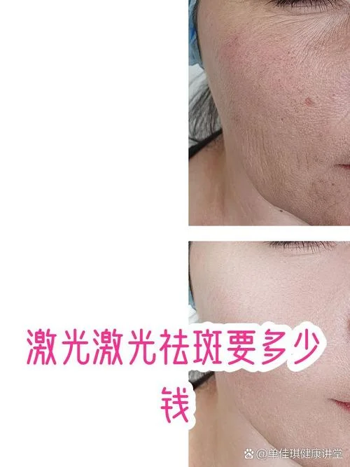 激光去除斑点多少钱_1