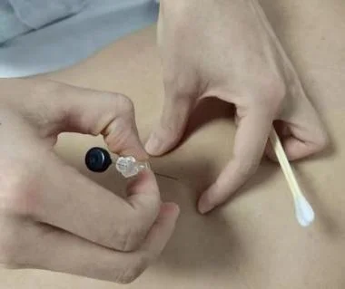 便秘埋线多少钱_1