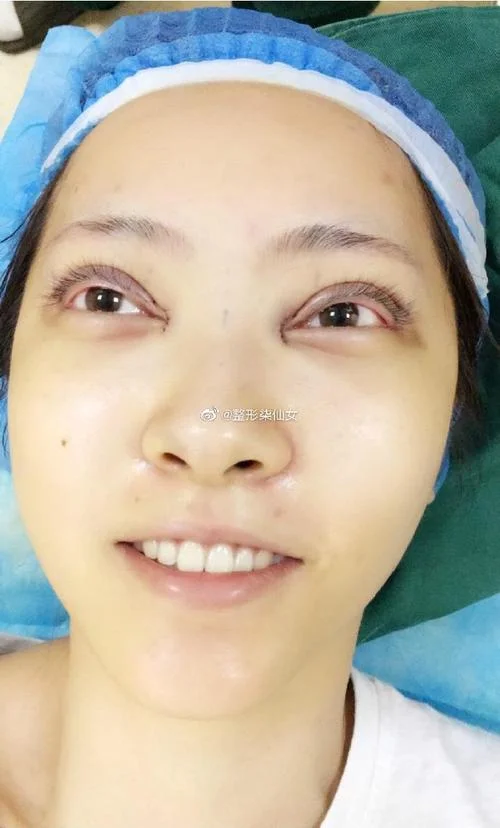 苏州双眼皮修复多少钱_2