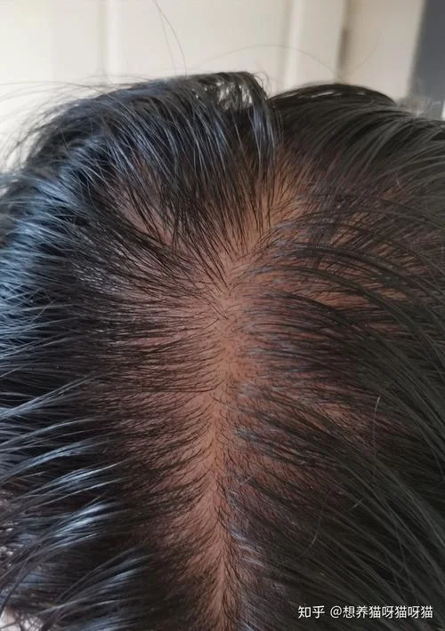 梦见秃头左边秃了一块_1