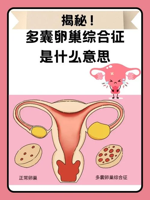 什么症状是多囊_1