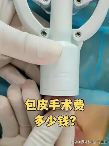 切除韩式包皮多少钱_1