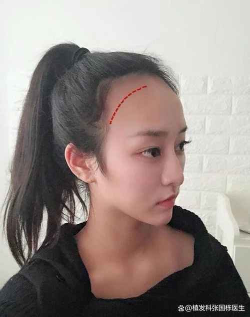 发际线整形要多少钱_2