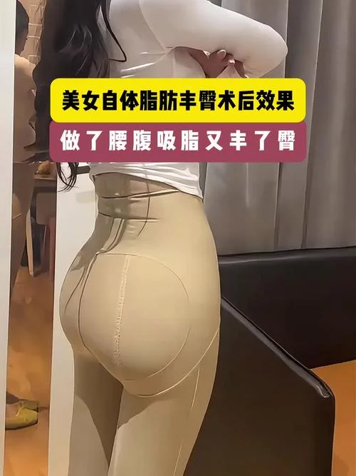 屁股吸脂需要多少钱_2