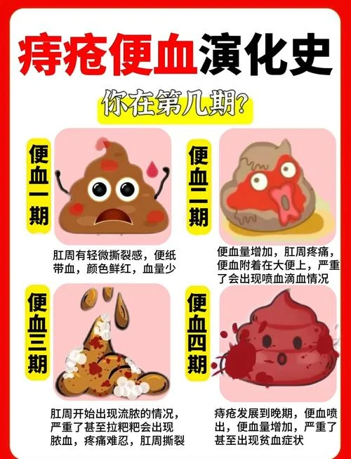 便血是什么意思_2
