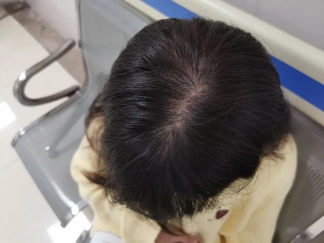 北京看脱发多少钱_2