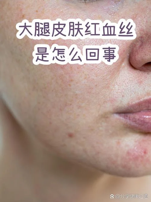 上有红血丝怎么办_1