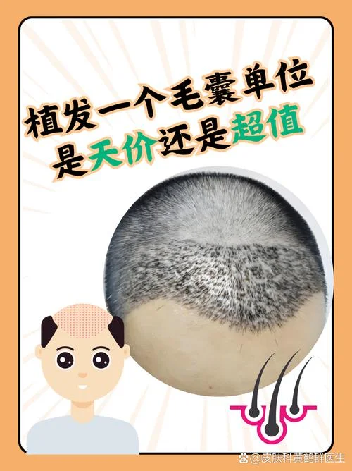 植发手术一般多少钱_1