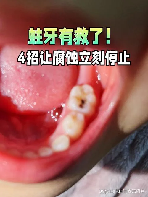 梦见掉了一颗蛀牙下牙_1