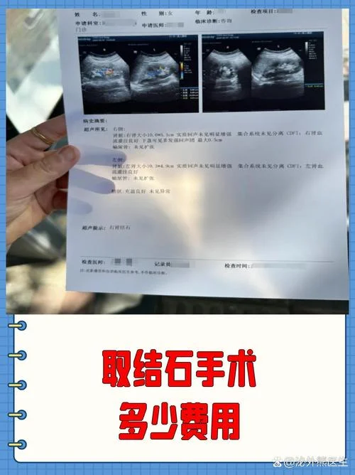 一般胆结石手术多少钱_1