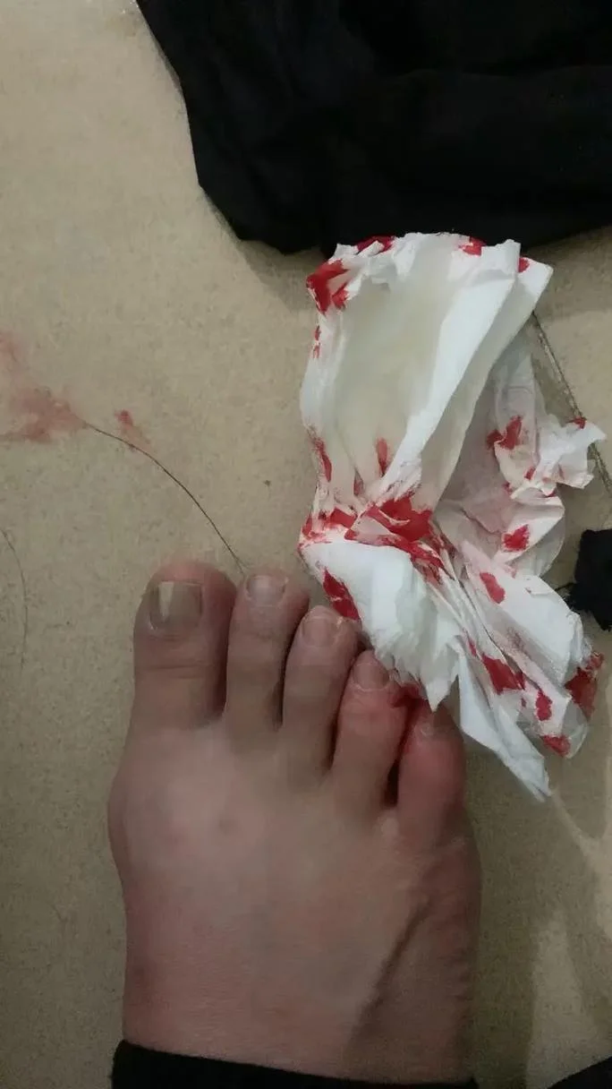做梦被老鼠咬了脚是什么意思-做梦被鼠咬脚含义