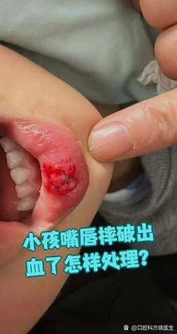 梦见嘴唇流血不止_1