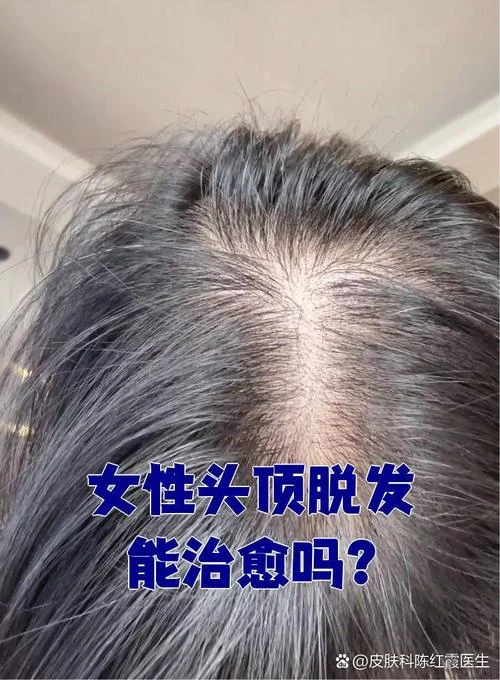 女人梦见掉头发秃顶_1