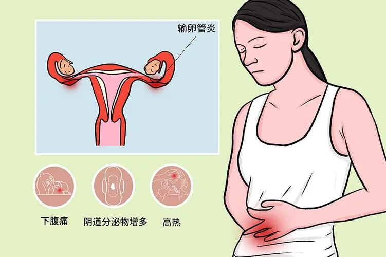 什么是附件炎症-什么是附件炎