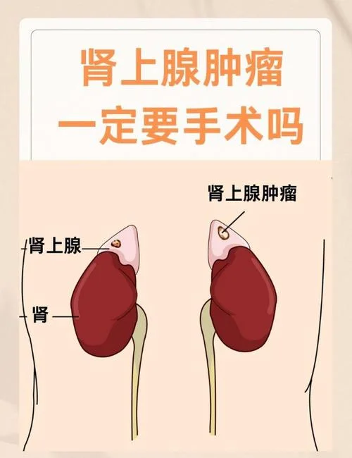 肾上腺瘤术后复查项目-肾上腺瘤术后复查项目