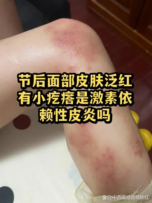 梦见自己过敏出一脸疙瘩_1