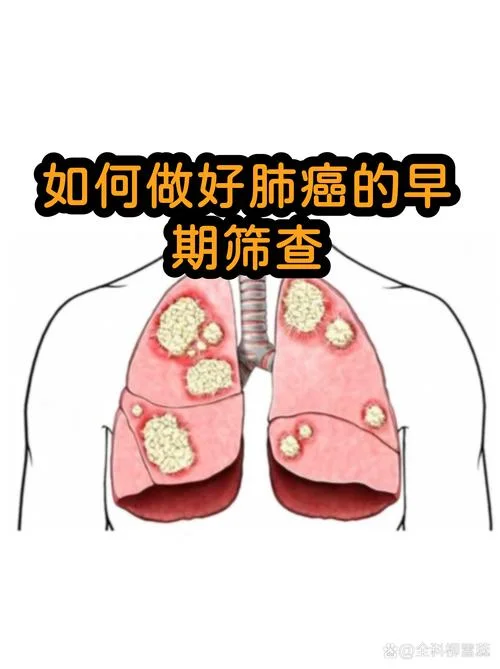 如何筛查早期肺癌_1